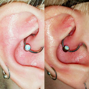 piercing bumps and how to treat them