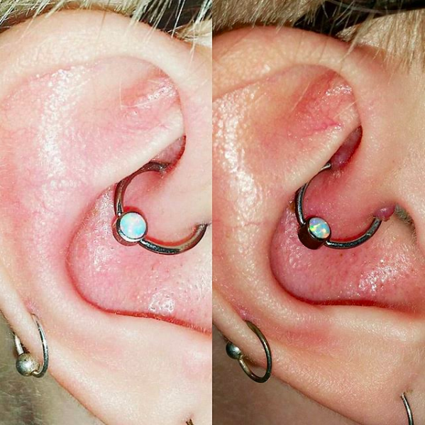 piercing-near-me-infected-bump-on-ear-lobe-piercing