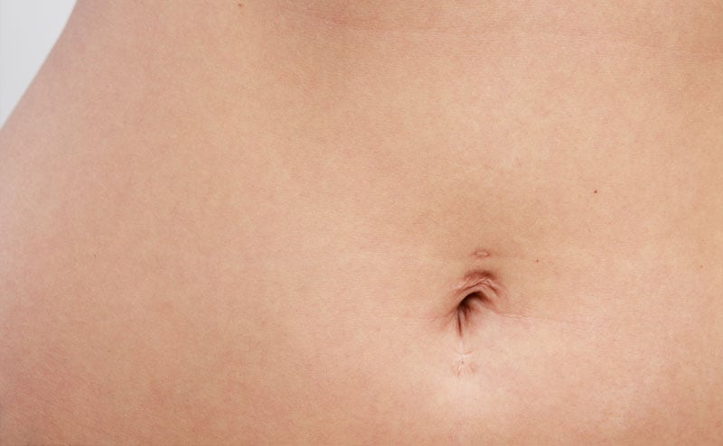 Belly piercing scar