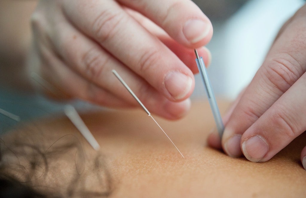 Person Getting Acupuncture